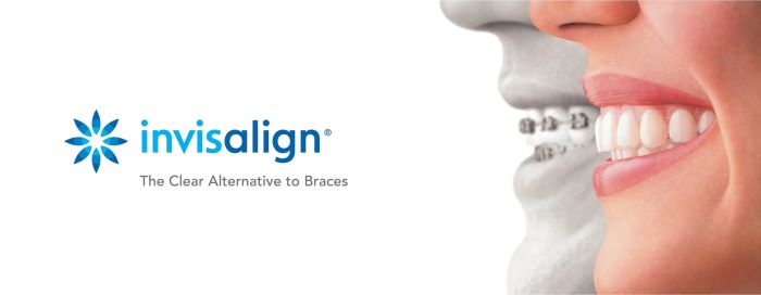 Advantages of Invisalign