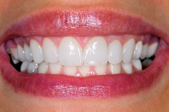 Jaw and Gum Resorption, Brush & Floss Dental Center