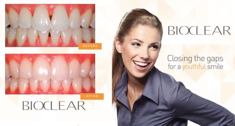 Bioclear Veneers