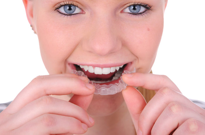 Invisalign Clear Braces