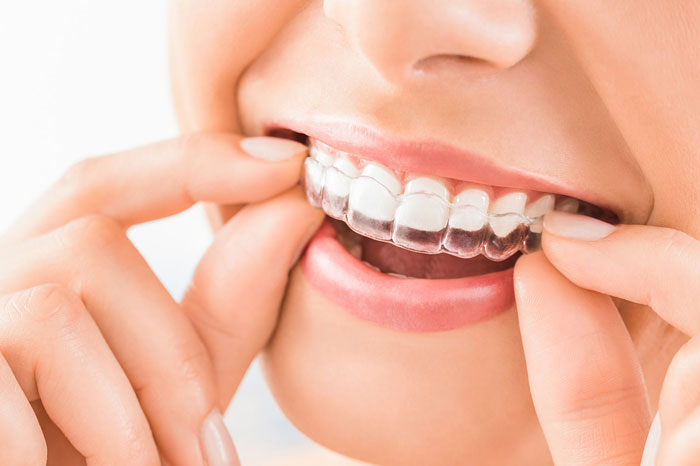 Invisalign Aligners For Teens