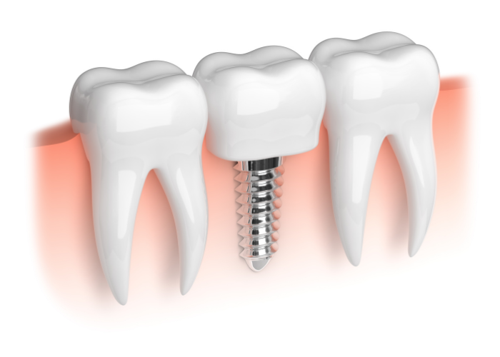 dental implant Coeur d Alene