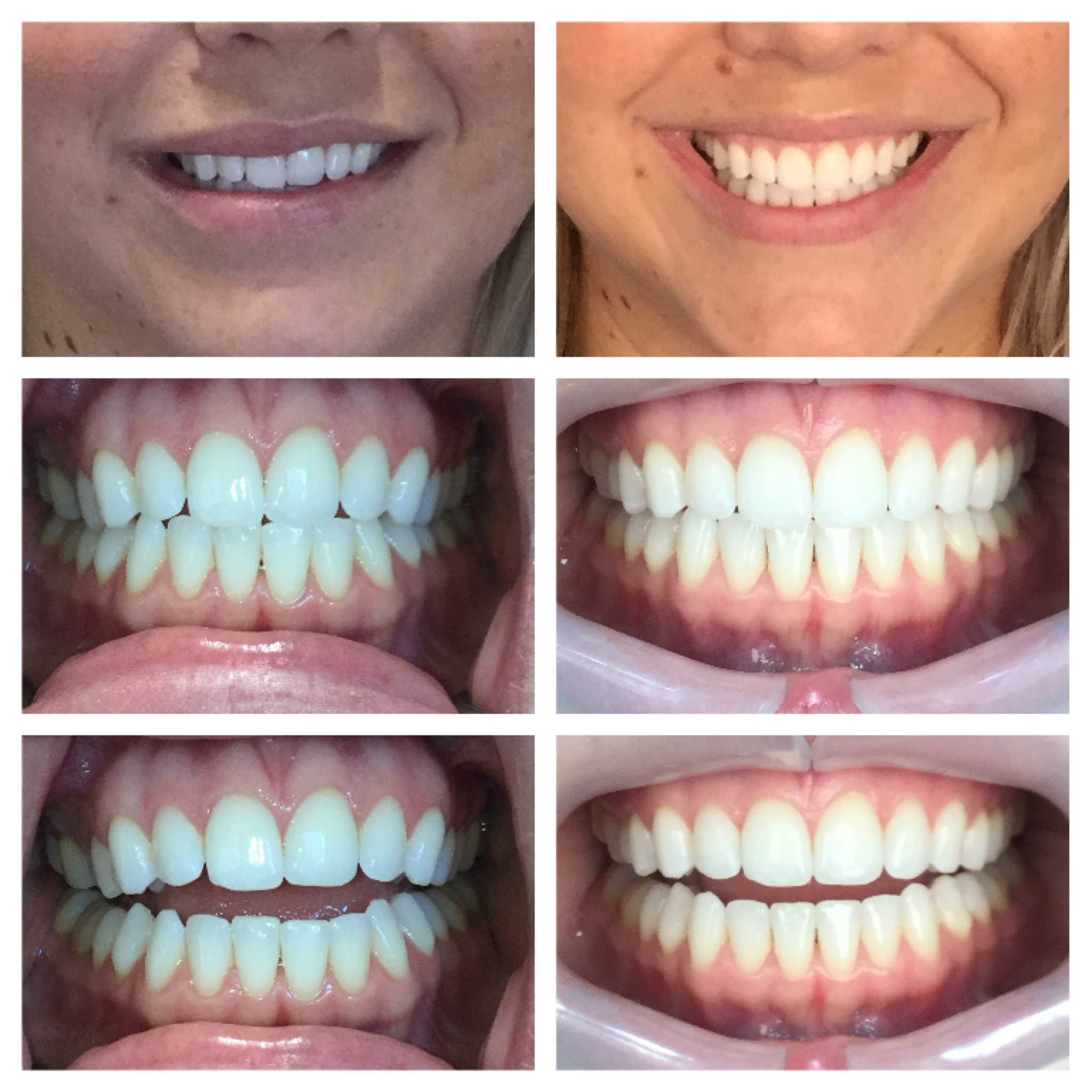 What You Need To Know About Invisalign Treatment - Prairie Pines Dental  Centre