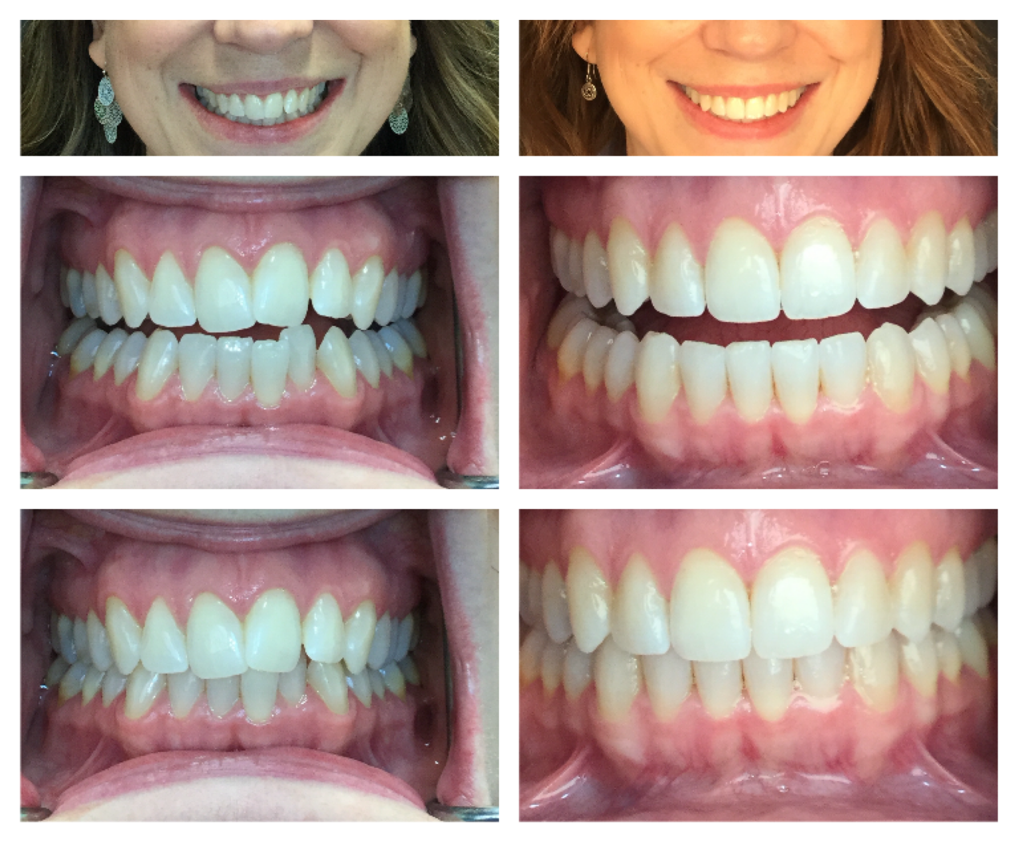 Before & After Invisalign