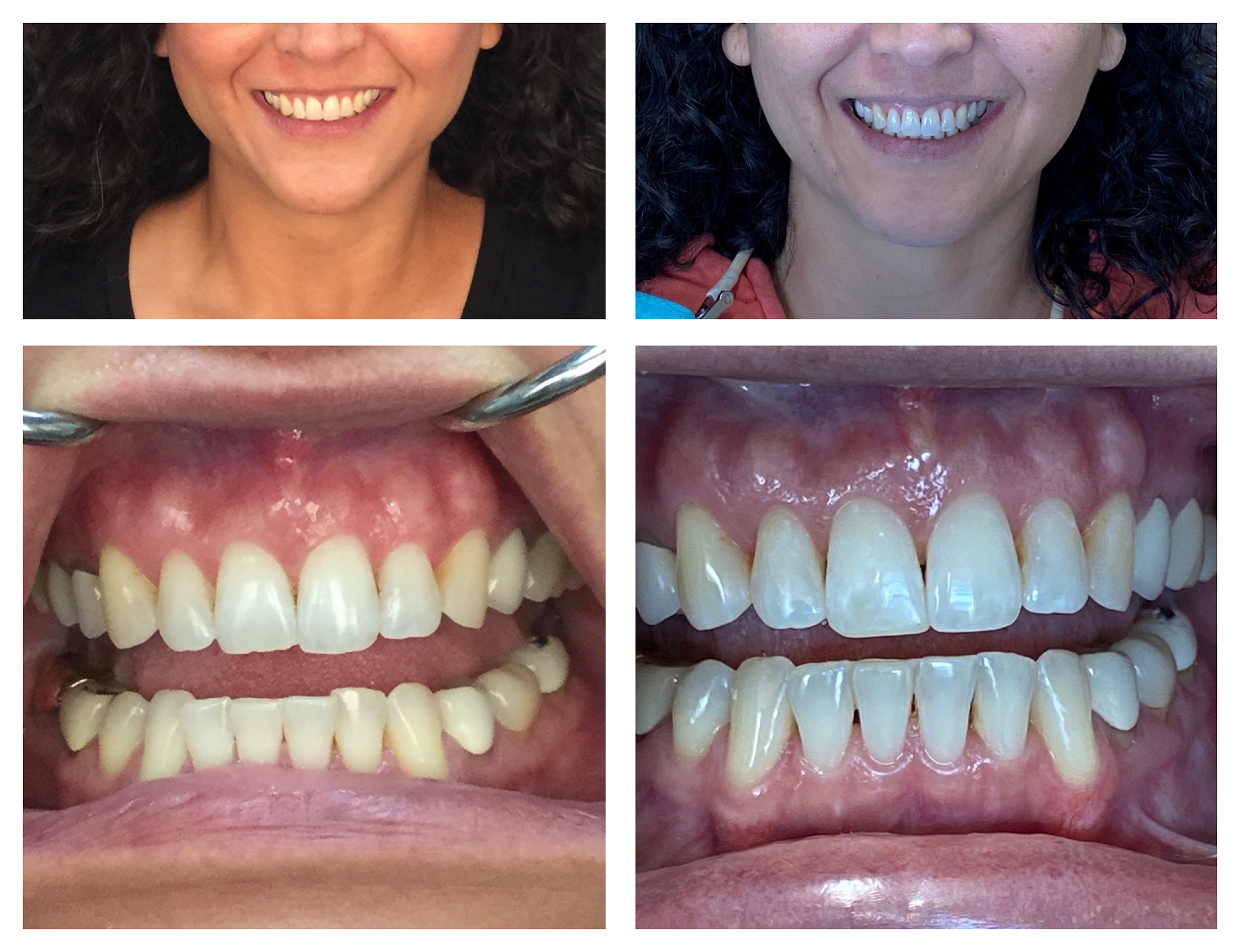 Invisalign Learning Center Coeur d'Alene - Invisalign Smile Gallery ID