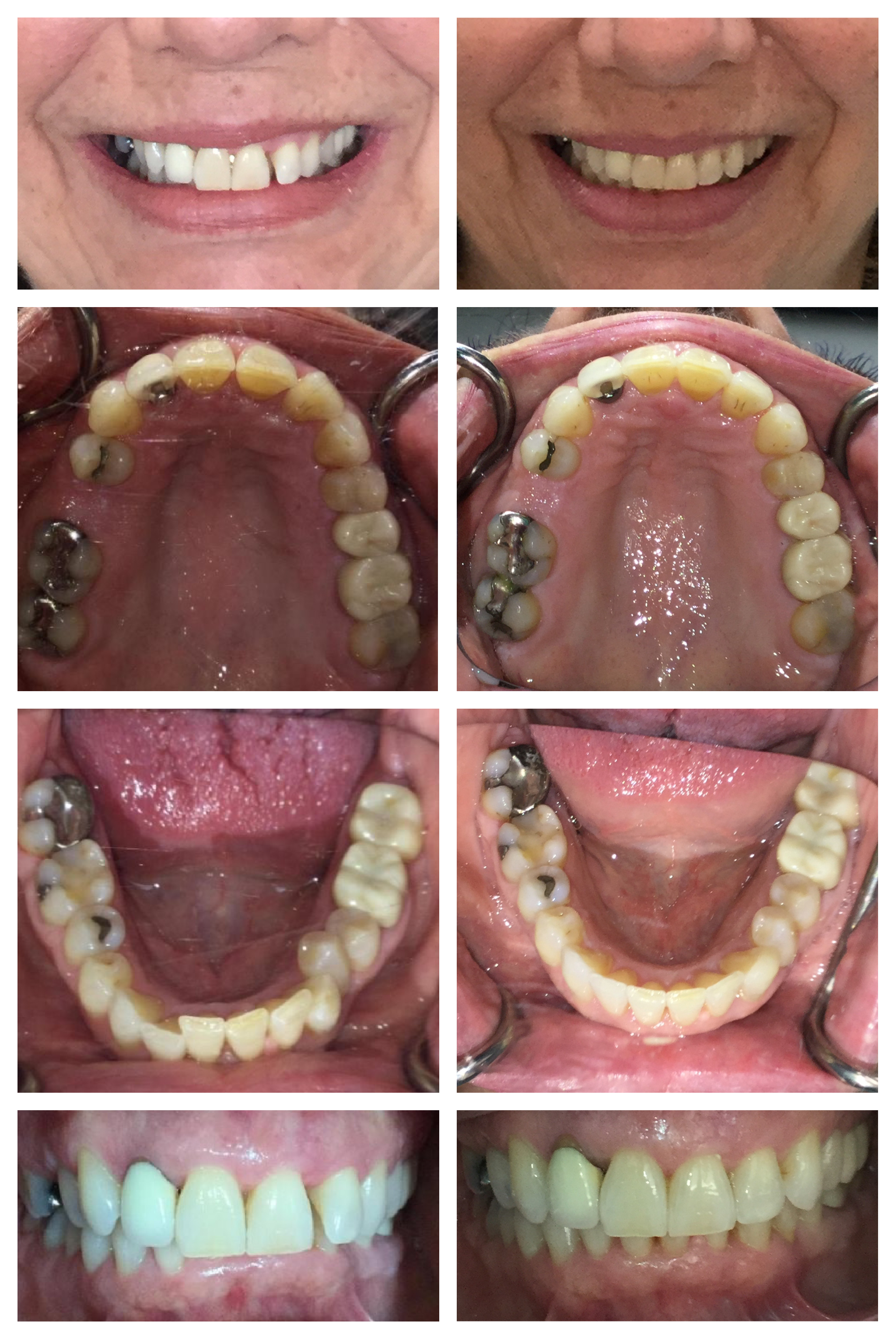 Ceramic braces — Medissa Clinic